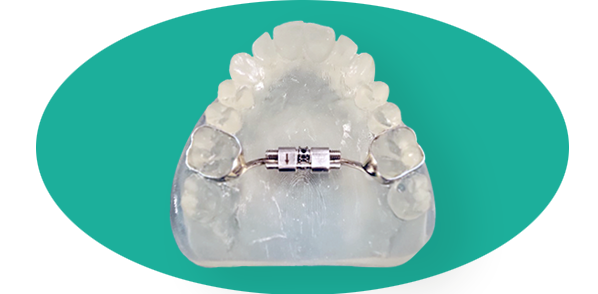 Palatal Expander